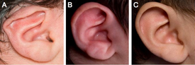 Ear splint effects